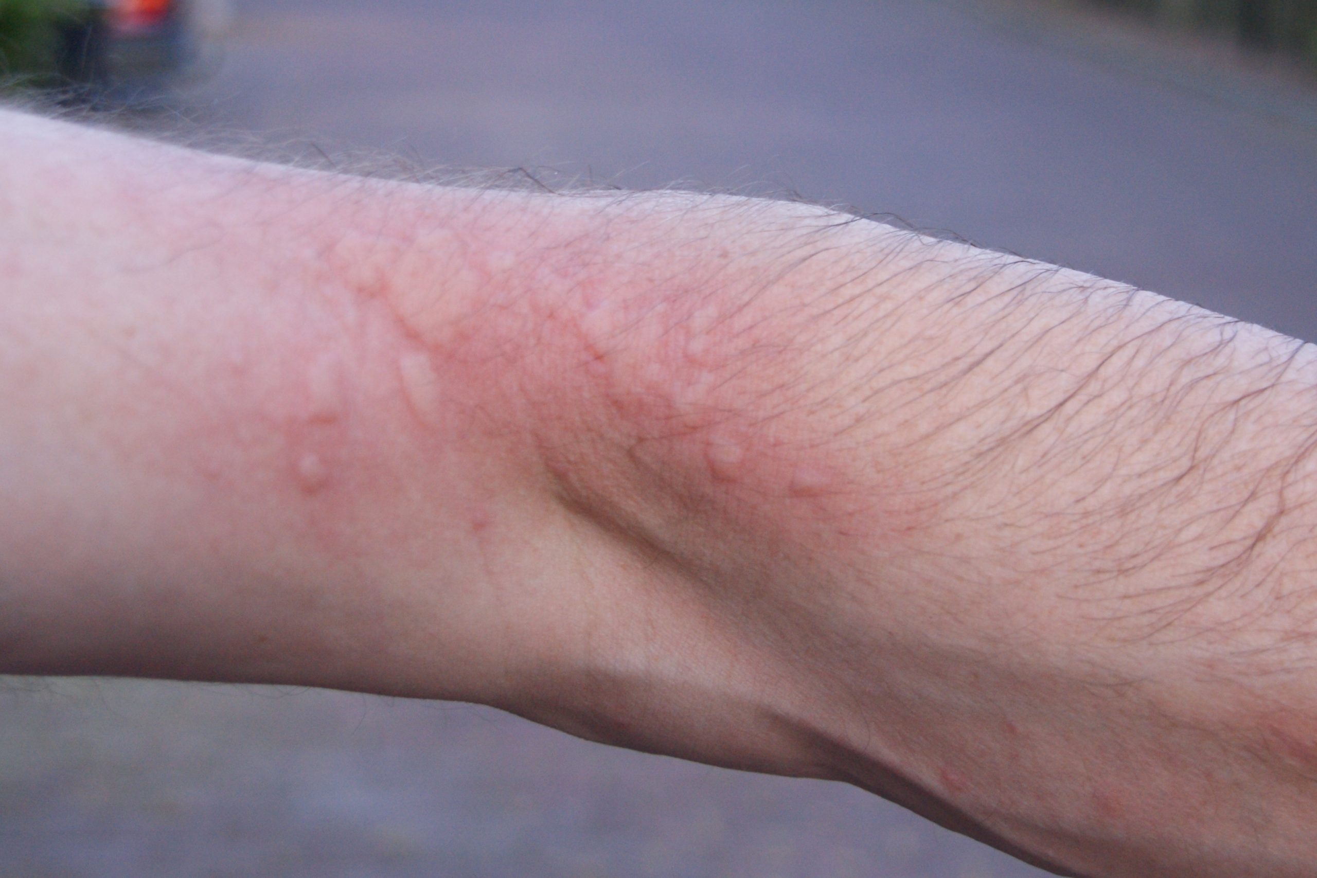 OPM rash on elbow.JPG