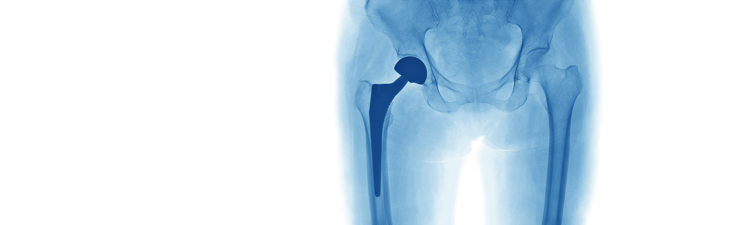 Implant Suppliers, National Joint Registry