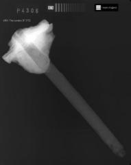 x-ray of hammer, laid diagonally with head at top left, concretion showing up as white around the head.