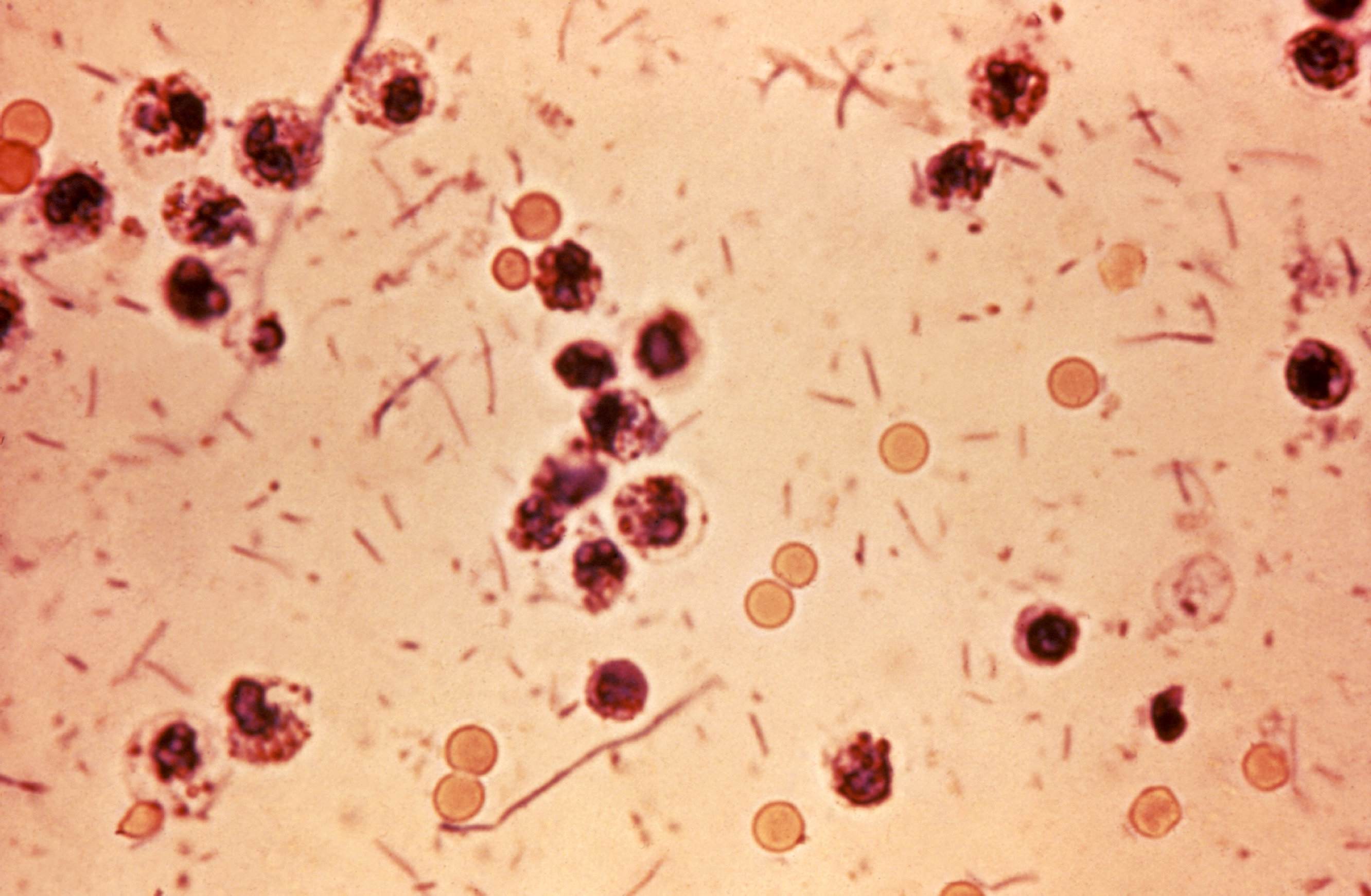 Photomicrograph revealed stool exudates in a patient with shigel