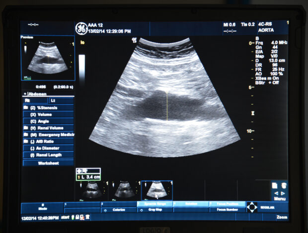 An ultrasound scan of the abdominal aorta.