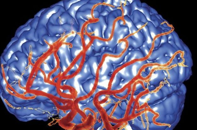 Brain scan of a dementia patient