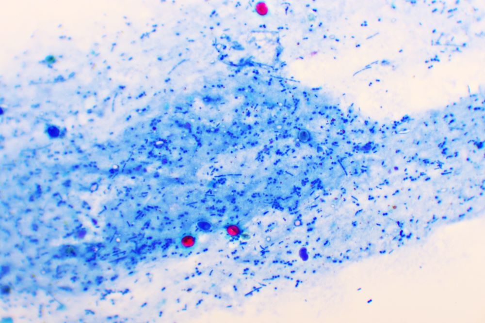 Cryptosporidium parvum protozoa positive (red sphere shape) in human stool smear