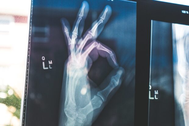 x-ray image of hand with thumb and fingers forming OK sign