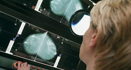 oking at breast scans on a lightboard display.