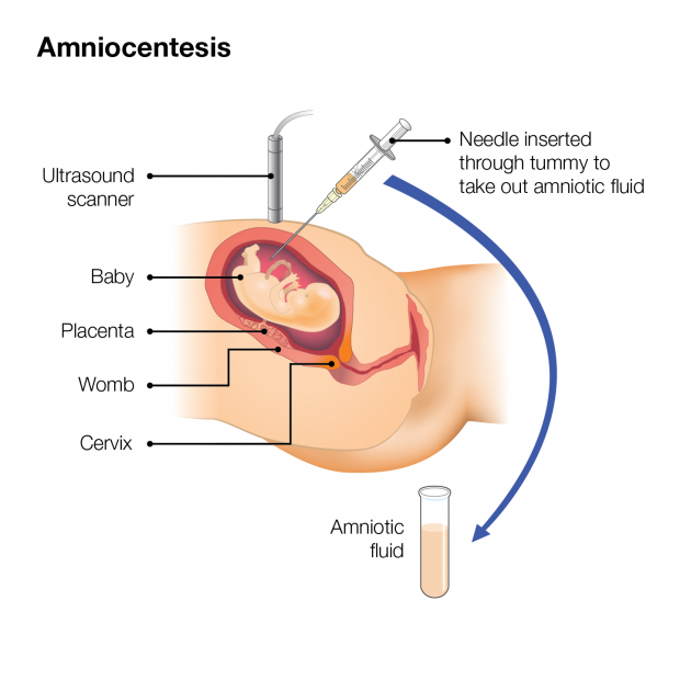 illustrations showing what amniocentesis and CVS tests involve