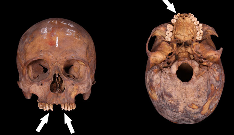 A skull with rounded teeth and missing the both maxillary central incisors