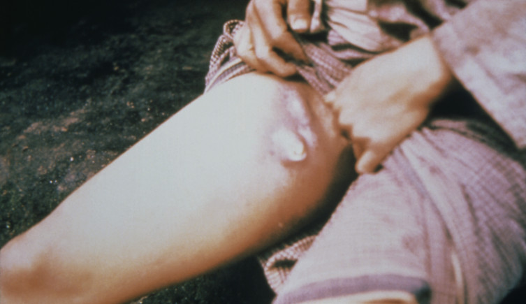 A person rolls up a trouser leg to reveal a buboe on their leg.