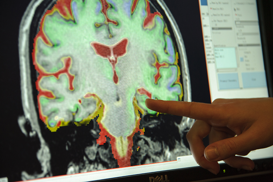Scan of brain with Alzheimers